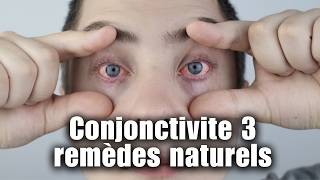 Conjonctivite  3 remèdes naturels pour soulager vos yeux [upl. by Hyman728]