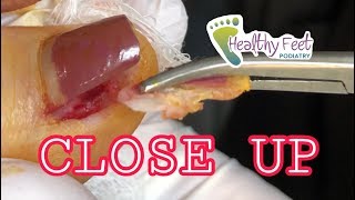 Close Up Ingrown Toenail Removal Painful Ingrown Nail [upl. by Annirok42]