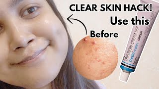 How to Use Tretinoin Correctly Before amp After Results [upl. by Lenahs]