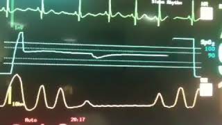 Cheyne Stokes Respiration recorded on cardiac monitor [upl. by Liek]