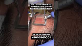 co2 laser treatment for acne scars  DrLalit Kasanas [upl. by Offen422]