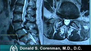 What Are Osteophytes  Spinal Bone Spurs  Anatomy  Degenerative Disc Disease [upl. by Cary]