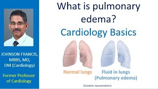 What is pulmonary edema Cardiology Basics [upl. by Kelby]