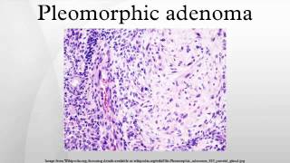 Pleomorphic adenoma [upl. by Drolet755]