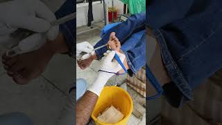 Full procedure of cauterization in Plantar corns [upl. by Htilil]