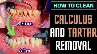 DENTAL CALCULUS and TARTAR removal  TARTRECTOMY before and after DENTAL CLEANING [upl. by Ajuna]