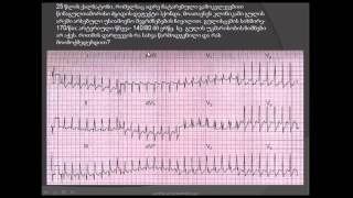 ეკგ  სუპრავენტრიკულური ტაქიკარდია წინაგულოვანი ტაქიკარდია  წინაგულთაშორისი ძგიდის დეფექტი [upl. by Clarisse374]