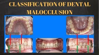 Trailer  Classification of dental malocclusion [upl. by Codi]