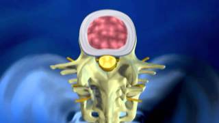 Herniated Disc Explanation [upl. by Adnerad]