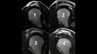 Types of acromion [upl. by Anderer]