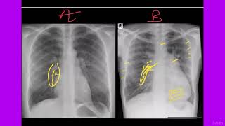 CONGENITAL HEART DISEASES amp EISENMENGER SYNDROME HOW TO APPROACH ON CHEST RADIOGRAPh BY DR NAEEM🚦 [upl. by Martin]