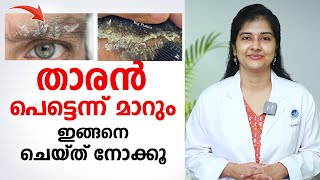 താരൻ പെട്ടെന്ന് മാറും ഇങ്ങനെ ചെയ്താൽ  Dandruff Treatment at Home  DrRadhika SBhat [upl. by Ardnak815]