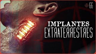 ⭕ Implantes extraterrestres  ¿tecnología alienígena  PULSO 66 ⭕ [upl. by Artemus]