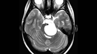 Pilocytc Astrocytoma [upl. by Eydie949]