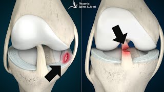 Is your knee pain coming from an ACL tear or Meniscus injury How to tell [upl. by Yehc]