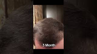 Hair Transplant Result  Hair Transplant Timelapse  Hair Transplan Before and After hairtransplant [upl. by Sieber]