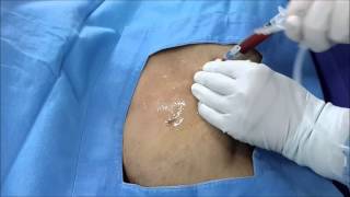 Ultrasound Guided Axillary vein Catheterization [upl. by Aydan546]