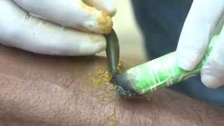 Hirudo Medicinalis Leech Therapy  Nadipathy  Kakinada [upl. by Nivat582]