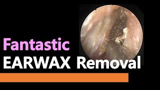 Fantastic huge EARWAX removal [upl. by Farrison655]