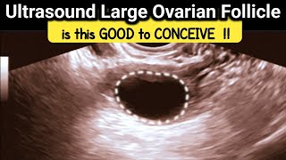 what is Large Ovarian Follicle  is it GOOD to CONCEIVE  TVS Ultrasound [upl. by Napas]