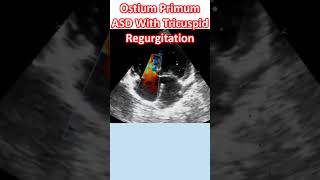 Ostium Primum ASD With Tricuspid Regurgitation [upl. by Ihtak627]