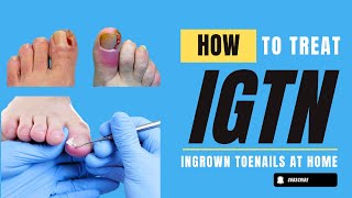 Ingrown Toe nails Causes Treatment and Prevention [upl. by Nawud600]