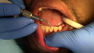 HEAVY TARTAR REMOVAL HIGHLY SATISFYING dental satisfying dentist [upl. by Kcirdef987]