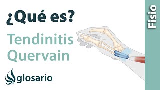 TENDINITIS DE DE QUERVAIN  ¿Qué es [upl. by Anon]