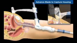 TSPeC® Illustrated Procedure  German [upl. by Otrebmuh702]