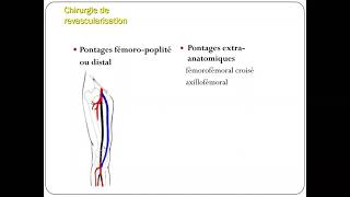 Traitement chirurgical des AOMI Artériopathies Oblitérantes des Membres Inférieurs [upl. by Seen]