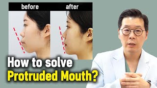 ENJP How to solve Protruded Mouth l Korean Protruded Mouth surgery case review [upl. by Linden]