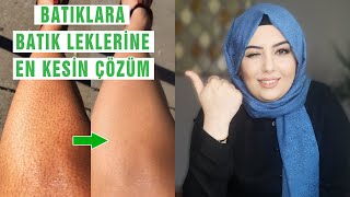 Pürüzsüz Bacaklar İçin Batıklara ve Batık Lekelerine En Kesin Çözüm [upl. by Solegna]