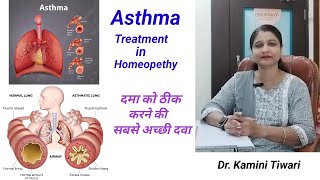 Asthma  Asthma treatment  दमा को ठीक कैसे करें  homeopethic treatment for asthma [upl. by Enert]