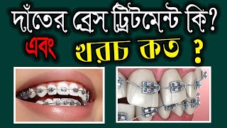 দাঁতে ব্রেস পড়ানোর খরচ কত টাকা  Orthodontics braces treatment cost dental braceby smile bd [upl. by Anrahs]