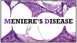 Menieres disease Idiopathic endolymphatic hydrops [upl. by Cowan570]