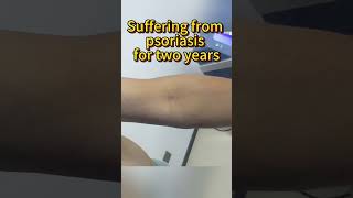 Suffering from psoriasis for two years psoriasis [upl. by Roinuj234]