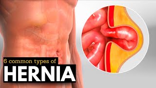 Hernia Breakdown Discovering the 6 Most Prevalent Types [upl. by Darryl]