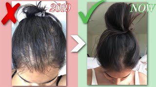 HOW I GREW MY HAIR BACK NATURALLY  QampA BEFORE amp AFTERS HAIR LOSS STORY  RESULTS IN JUST 1 MONTH [upl. by Neirad881]