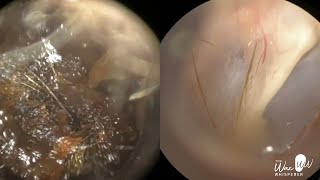 157  Severe Ear Wax Extraction From Difficult Twisty Ear using the WAXscope®️ [upl. by Ainaznat269]