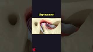 Temporomandibular Joints Arthritis And Dislocated Articular Disc health wellness shorts [upl. by Dunson]