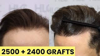 FUE Hair Transplant and Beard Transplant in Turkey  4900 Grafts [upl. by Crudden]