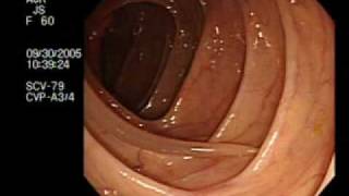 Colonoscopy Demonstrating a Moving Worm  NEJM [upl. by Sirromad]