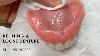 Relining a Loose Denture  Full Process [upl. by Terraj845]