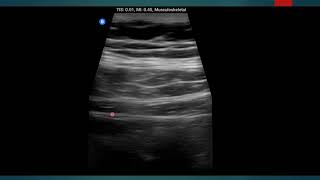 Subcostal TAP Block Ultrasonography in 1 Minute [upl. by Rases]