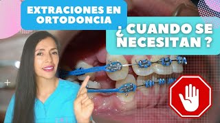 Extraciones en ortodonciabrackets 7 Razones para hacerlas [upl. by Arrec]