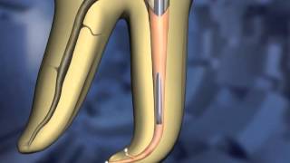 Continuous Wave technique  Dentsply Sirona [upl. by Kcirdet]