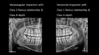 사랑니 난이도 평가 Classification of third molar impaction [upl. by Dam628]