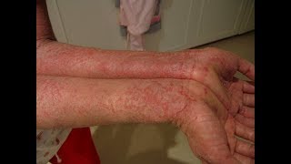 Treatment of eczema and other skin diseases [upl. by Niala]