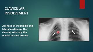 CLEIDOCRANIAL DYSPLASIA  Xray  Radiology [upl. by Augusta]