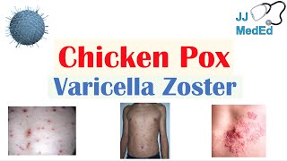 Chickenpox  Varicella Zoster Virus  Pathogenesis Signs and Symptoms Diagnosis and Treatment [upl. by Gale571]